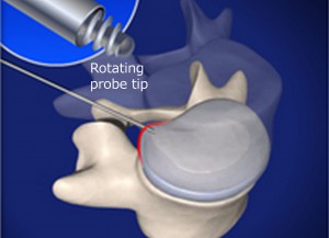 Ozone Discectomy | IPSC - Intervention Pain & Spine Center